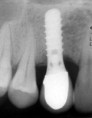 /album/dental-implant/implant-4-jpg/